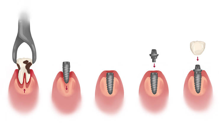 What is the process of endosteal dental implant?